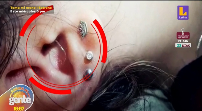 Adolescente se queja por un mal implante en el oído